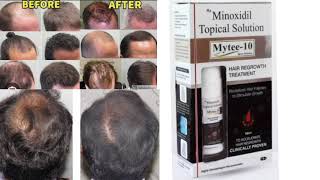 Mytee 10 Topical Solution HAIR REGROWTH TREATMENT Minoxidil Topical Solution [upl. by Hasina910]