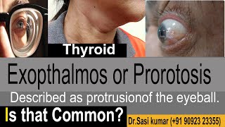 Exopthalmos or Prorotosis  Described as protrusion of the eyeball [upl. by Manlove]