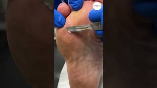 Neuroma Surgery Scar Debridement [upl. by Yetac]