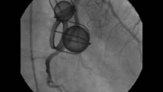 Two Views of the StarrEdwards Valves during Cardiac Catheterization [upl. by Ramiah]