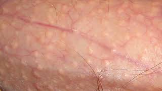 Learn about fordyce spots  what is adnexa [upl. by Faires]