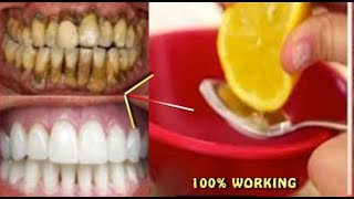 Turn Yellow Teeth To Pearl White and Shine Teeth Whiten at Home ll Lemon [upl. by Bruning748]