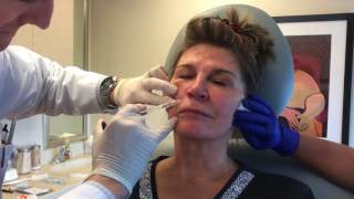 Botox Radiesse Restylane RefynePinski Dermatology and Cosmetic Surgery Chicago [upl. by Whitnell65]