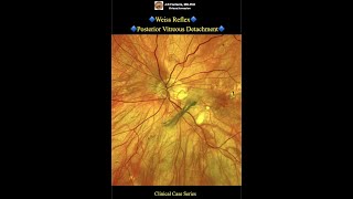 Weiss Reflex Posterior Vitreous Detachment [upl. by Cirek]