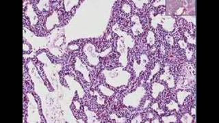 Histopathology Lung Interstitial pneumonia [upl. by Ogu962]