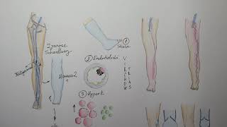 Phlebothrombose vs Thrombophlebitis vs Varikophlebitis [upl. by Gorges208]