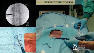 Percutaneous Screw Placement  Hyun Bae MD [upl. by Ainet289]