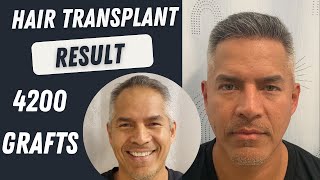 Hair Transplant 4200 Grafts Result Timeline 12 months  Hair Transplant Turkey Cost [upl. by Carolan]