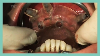 Maxillary overdenture on 6 implants [upl. by Egroej11]