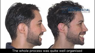 Jaw surgery Case  102 Jonathan  Sleep Apnea Lack of mandibular projection [upl. by Latoyia]