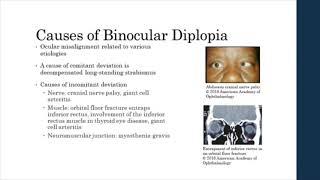 Binocular vs Monocular Diplopia [upl. by Yehudit]