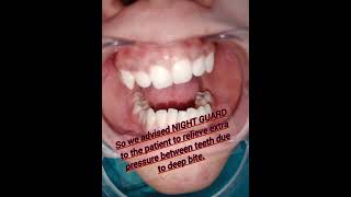 Dental NIGHT GUARDdentalcaredentistorthodonticsbestdentistrybookyourappointmentviralshort [upl. by Awe]