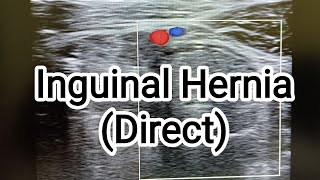 Inguinal Hernia Direct [upl. by Atilemrac]