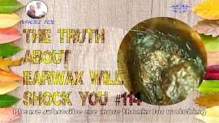 The Truth About earwax Will Shock You 114 [upl. by Eadie]