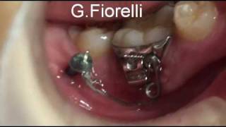 Orthodontic Miniscrew in the mandible [upl. by Eelidnarb]