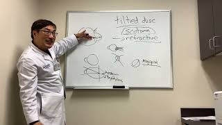 Scotoma in Tilted Disc Syndrome [upl. by Enigroeg140]