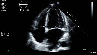 TTE  Aortic Valve Endocarditis with Aortic Regurgitation [upl. by Sllew18]