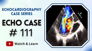 Echocardiography Case 111  Echocardiogram Interpretation Made Easy  TOACS [upl. by Auroora]