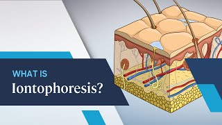 What is Iontophoresis [upl. by Barnaby408]