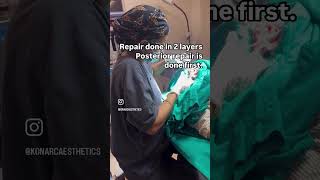 Torn ear lobe repair surgery earloberepair cosmeticsurgery cosmeticsurgery plasticsurgery [upl. by Eenaffit]