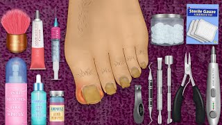 ASMR🎧Ingrown Toenail  Best removal treatment animation 💖 [upl. by Rezeile]