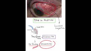 Scleritis  Case Discussion In A Minute Mustknow Shorts [upl. by Chandless]