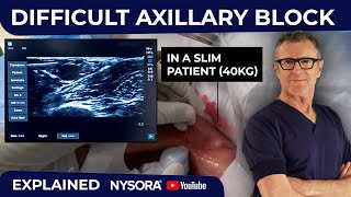 Slim but Tricky Axillary Block Challenges in Low BMI Patients [upl. by Som]