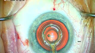 Zepto Precision Pulse Capsulotomy during Cataract Surgery [upl. by Ahsirak]