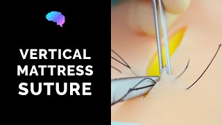 Vertical Mattress Suture  OSCE Guide  UKMLA  CPSA [upl. by Latashia]