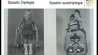 Cerebral Palsy CP  Spastic Diplegia Paraplegia Hemiplegia Sequelae Consequences Treatment Options [upl. by Reimer]