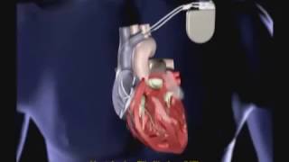 Implantable Cardioverter Defibrillator ICD [upl. by Anasor283]