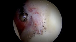 Labral Tear with High Grade Complexity of Tearing Degeneration and Bruising [upl. by Vergne966]