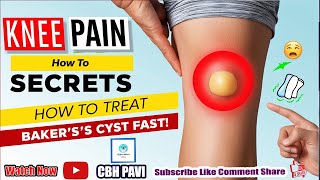 Bakers Cyst The Hidden Cause of Your Knee Pain [upl. by Winny991]