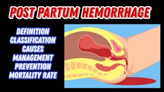 Post Partum Hemorrhage  Causes Classification Treatment  PPH  MisMedicine [upl. by Reeher]