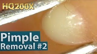 2 Pimpleacne Removal Close up 200X  Blackheads Removal  200倍でニキビを潰す芯を除去 [upl. by Eloccin]