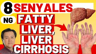 8 Senyales ng Fatty Liver Liver Cirrhosis  By Doc Willie Ong Internist and Cardiologist [upl. by Neltiak103]