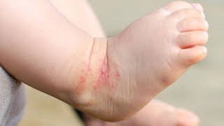 7 Tips to Manage Eczema Without Seeing a Dermatologist [upl. by Assi617]