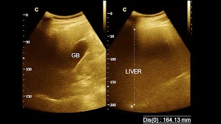 Hepatomegaly  Mild hepatomegaly with fatty change  Ultrasonography report  Amader Hospital [upl. by Estrin]