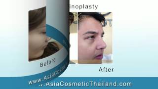 Before amp After Rhinoplasty in Thailand  Asia Cosmetic Hospital [upl. by Eenert]