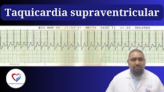 ¿Palpitaciones y mareos 😵 ¡No lo ignores La Taquicardia Supraventricular puede ser peligrosa [upl. by Ainet]