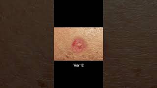 Basal Cell Carcinoma Skin Cancer Development Time Lapse Normal to Cancer Over 25 Years [upl. by Buchheim]