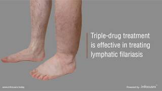 Tripledrug treatment is effective in treating lymphatic filariasis [upl. by Claiborn]