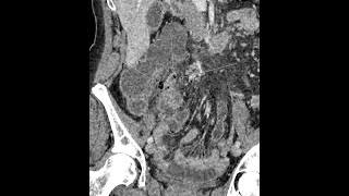 Appendicitis  perforated  complicated  appendicoliths present [upl. by Orodoet167]