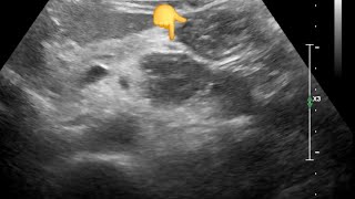 Diagnostic dilemma Pancreatic Lesion Jejunal Loop Mimicking Cancer on Ultrasound – CT Clarifies [upl. by Story202]