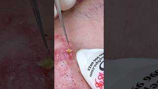 P001  SacDepSpa acne pimple sacdepspa blackheads [upl. by Einafats894]