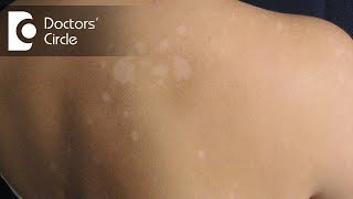 Managing round irregular skin patches not responding to topical creamsDr Rasya Dixit [upl. by Ardnoek]