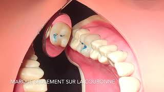 Couronne provisoire  Rebasages 33 [upl. by Gujral401]