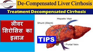 Decompensated liver cirrhosis  Decompensated liver disease [upl. by Marius]