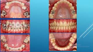 La tecnica de premolares vs tecnica de segundos molares en Ortodoncia [upl. by Ollecram]