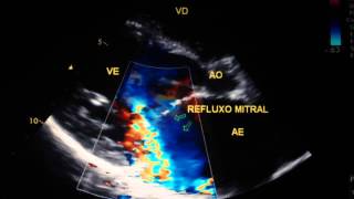 Insuficiência mitral importante [upl. by Enerod528]